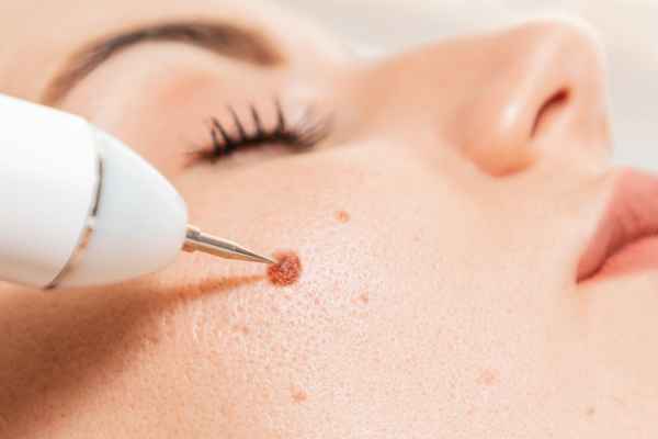 CryoPen: 5 Skin Concerns It May Be Used to Treat 3 What actually happens during a CryoPen treatment Kings Norton?