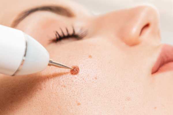 Dermatofibromas: What to Know About Treatment Options 4 Questions to ask before treatment