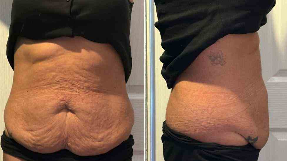 Lost the Weight but Not the Loose Skin? What You Should Know 1 Is It Definitely Loose Skin Kings Norton?