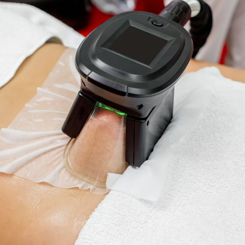 Fat Freezing treatment Kings Norton